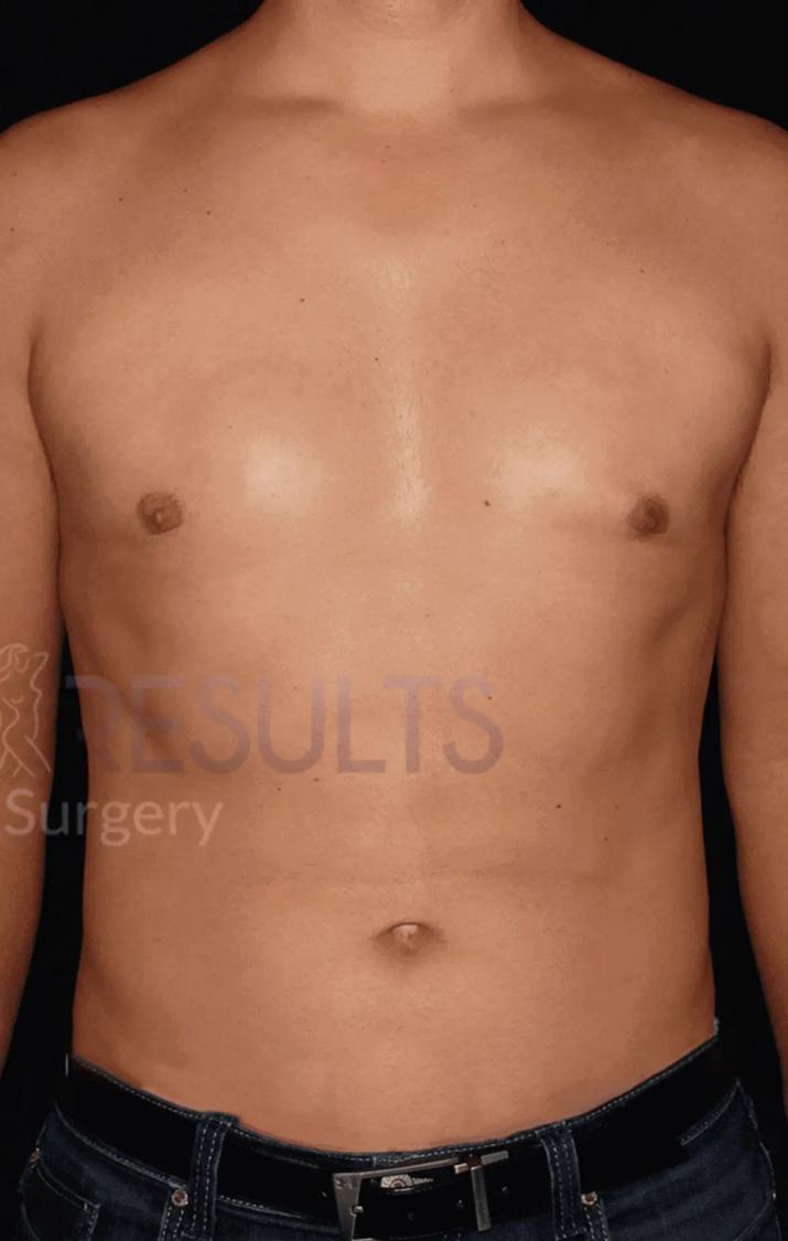 One-Stitch Gynecomastia after