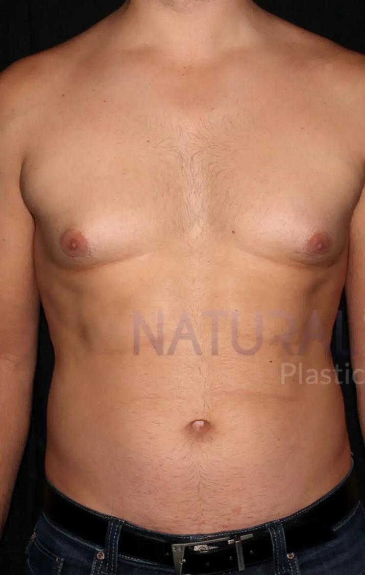One-Stitch Gynecomastia before