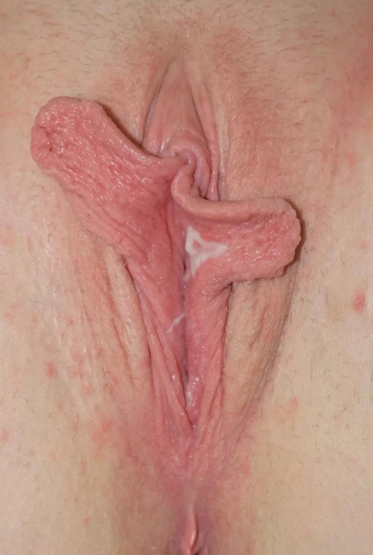Labiaplasty before