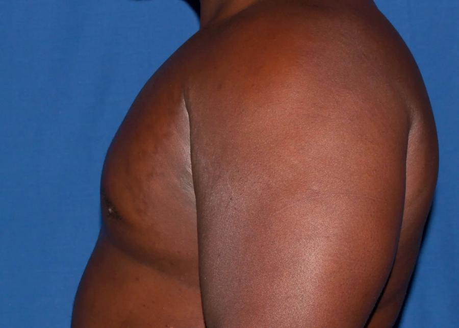 One-Stitch Gynecomastia after