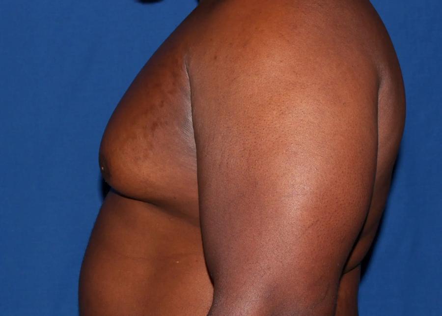 One-Stitch Gynecomastia before