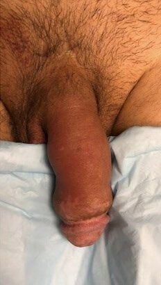 Penis Filler before