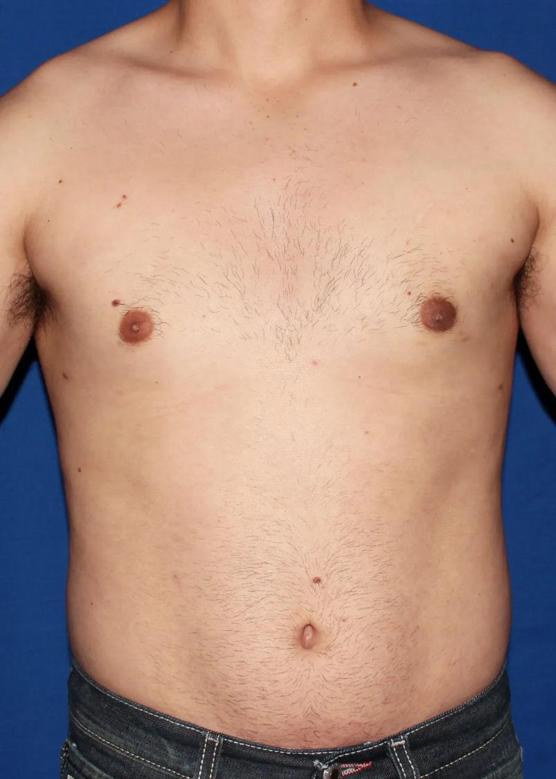 One-Stitch Gynecomastia after