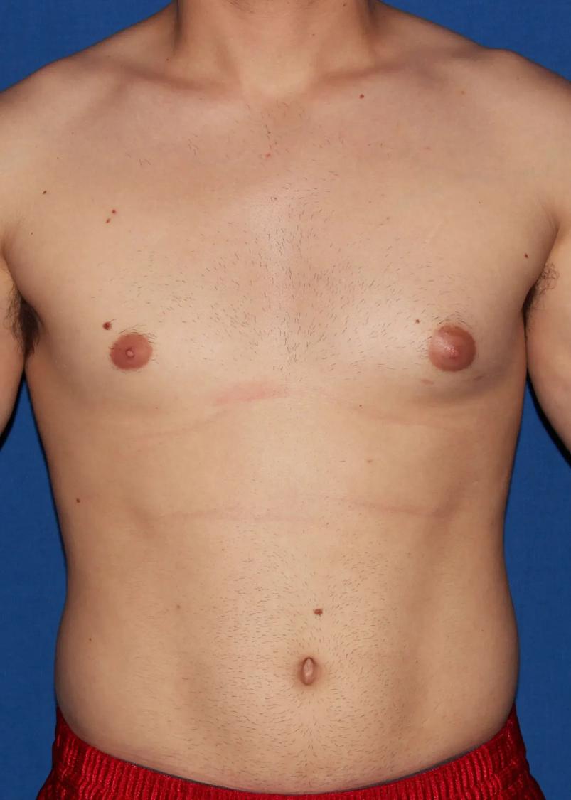 One-Stitch Gynecomastia before