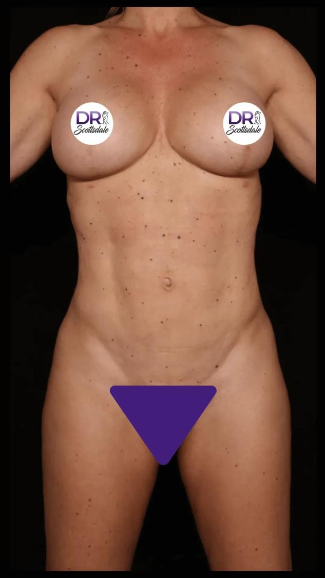 Vaser Lipo 360 (5L Max) after