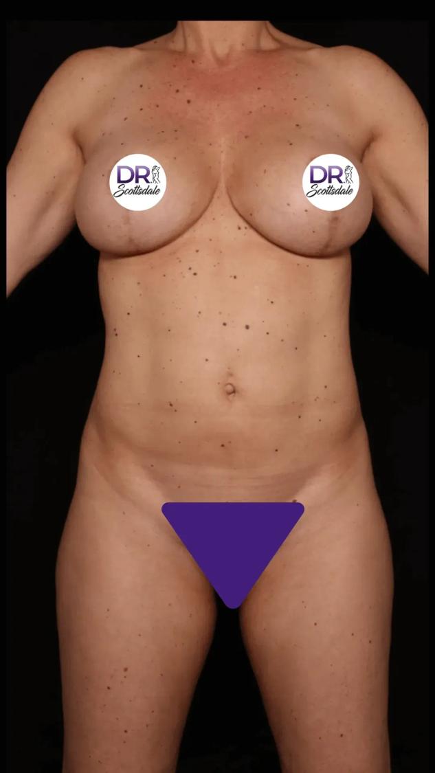 Vaser Lipo 360 (5L Max) before