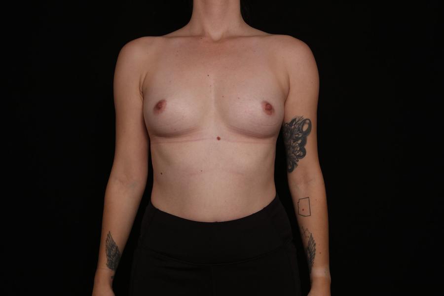 Before Breast Augmentation with Implants