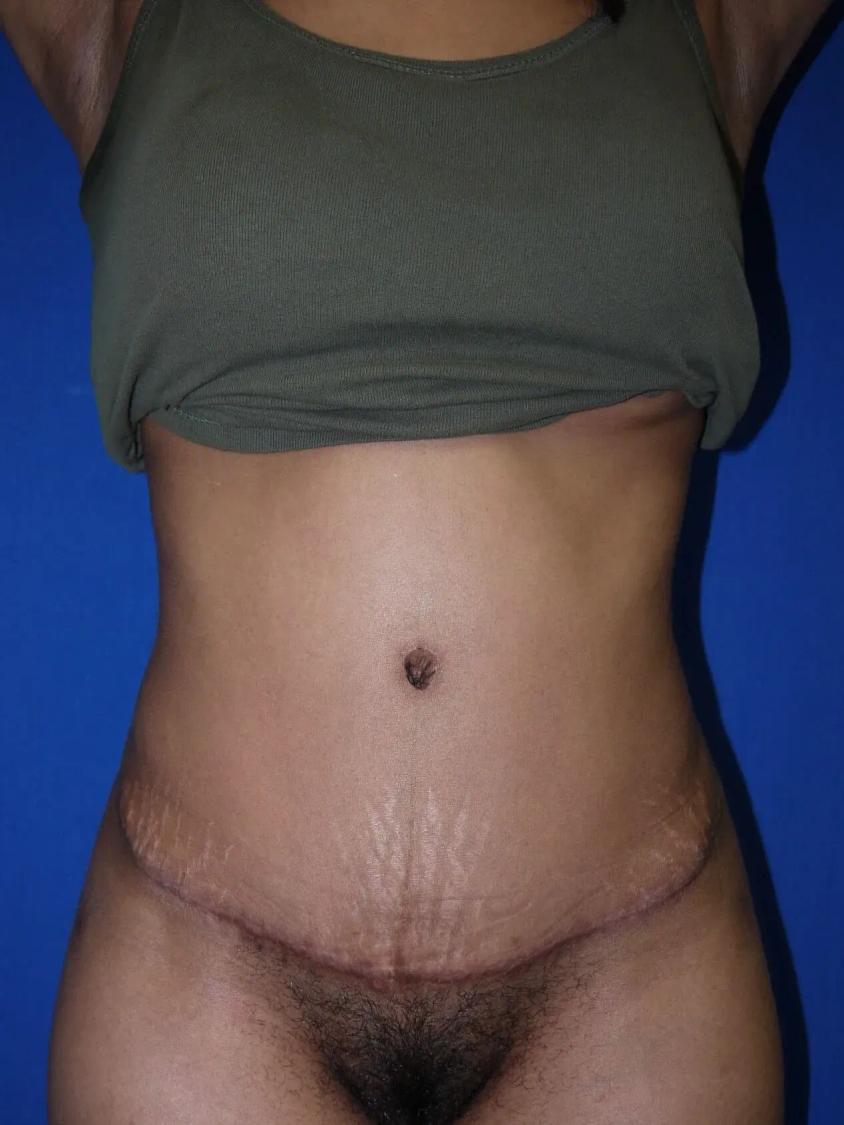 Tummy Tuck after