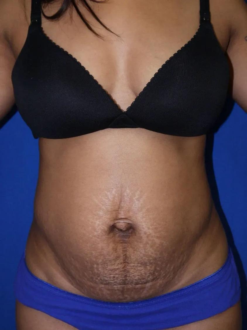 Tummy Tuck before