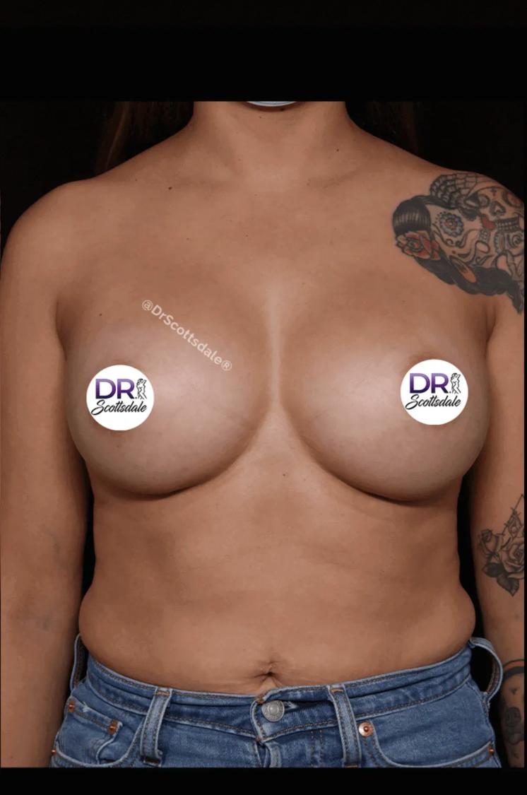 Breast Augmentation with Implants after