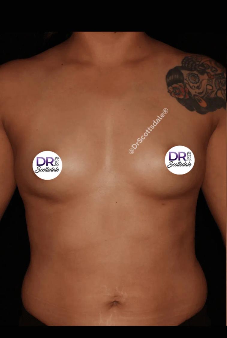 Breast Augmentation with Implants before