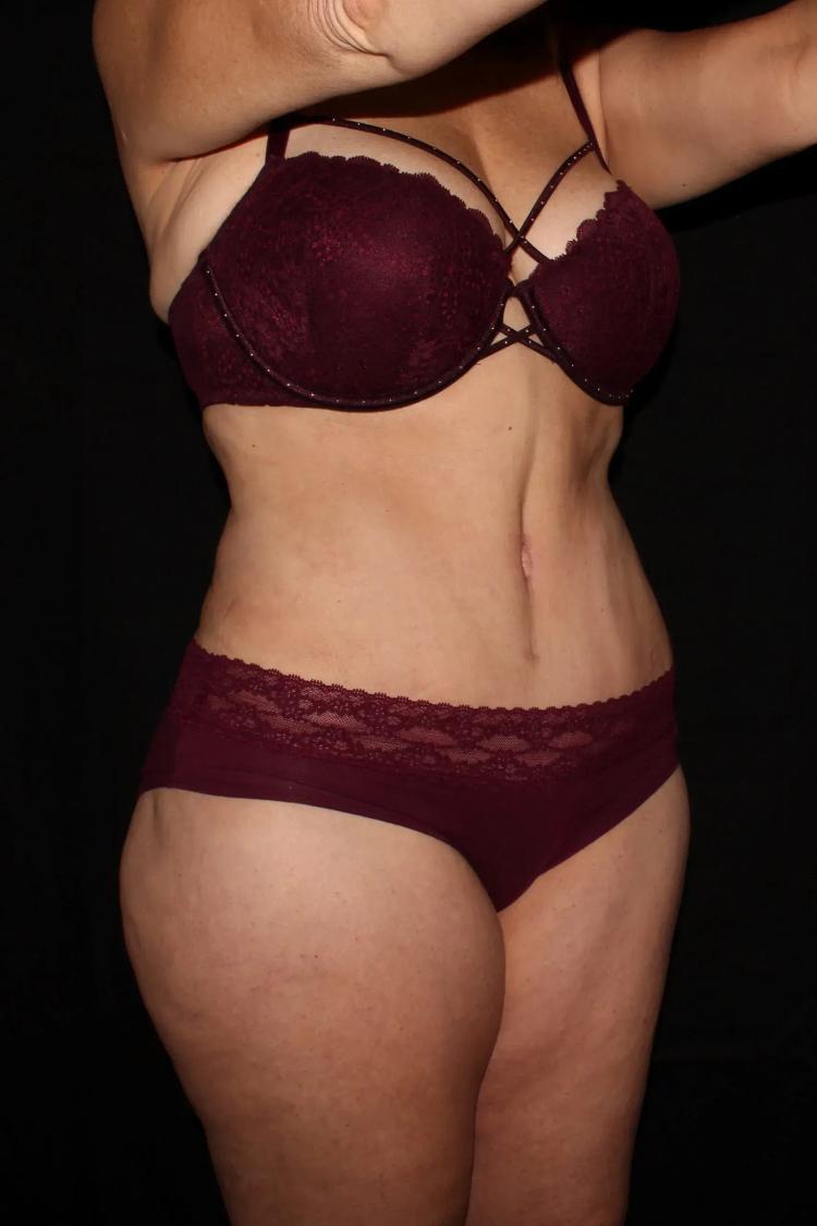 Tummy Tuck, view 2, after