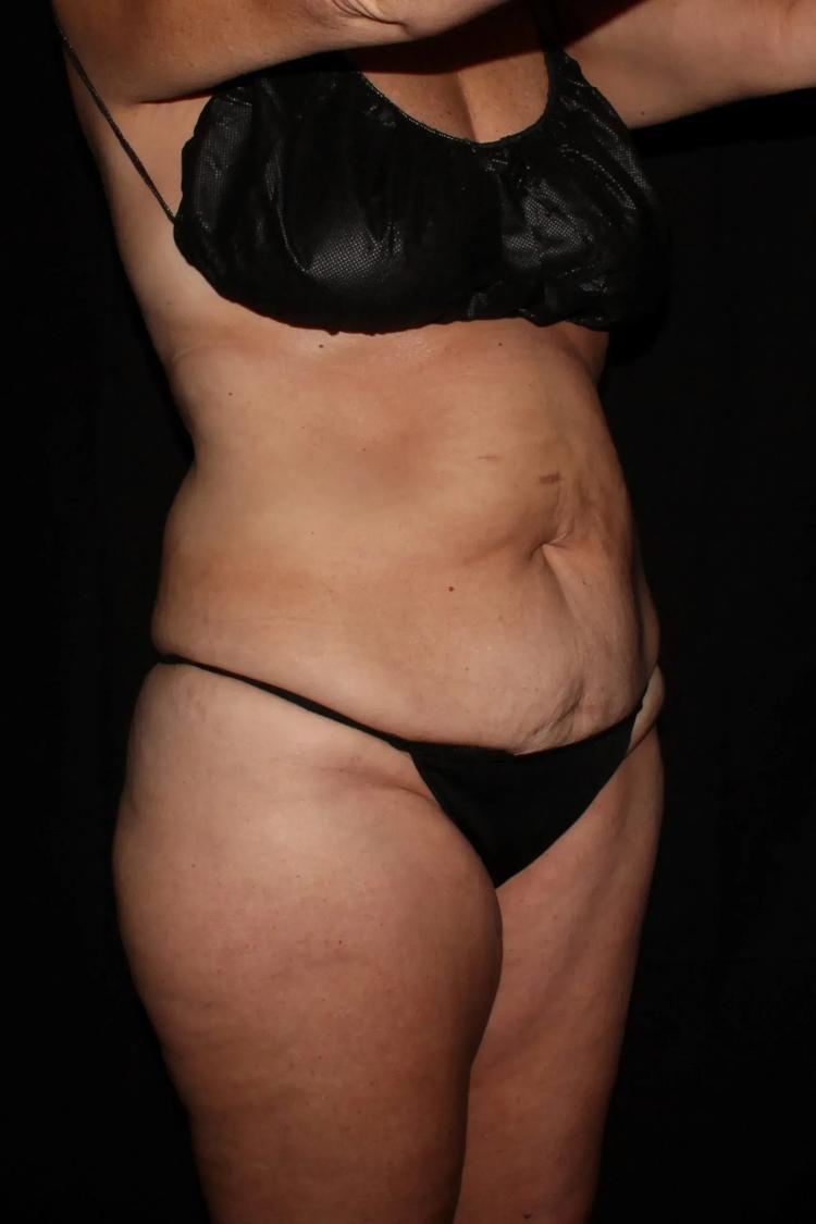 Tummy Tuck, view 2, before