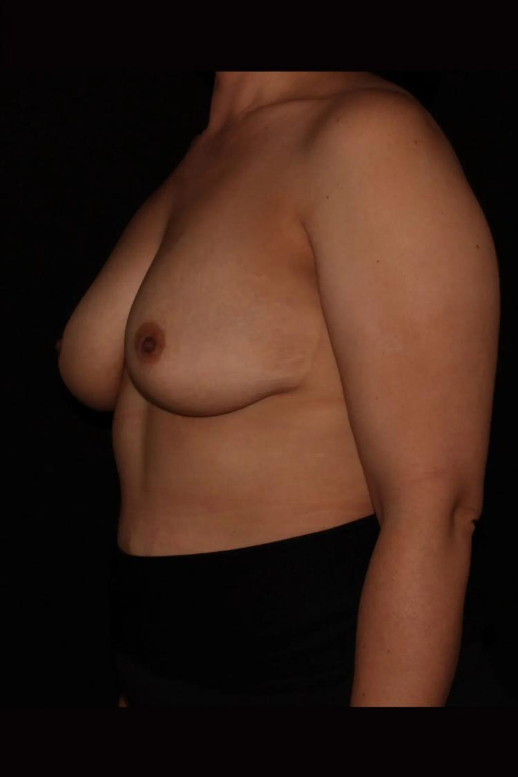 Breast Augmentation with Implants, view 2, before