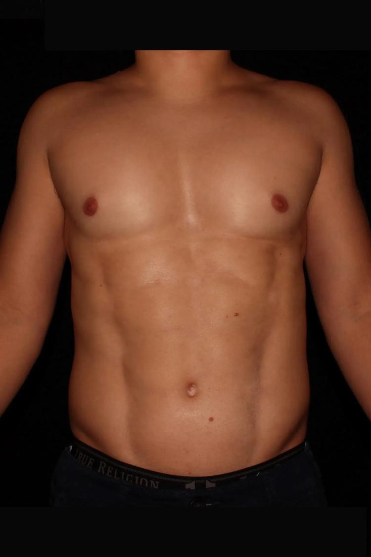 Vaser Lipo 360 (5L Max) after