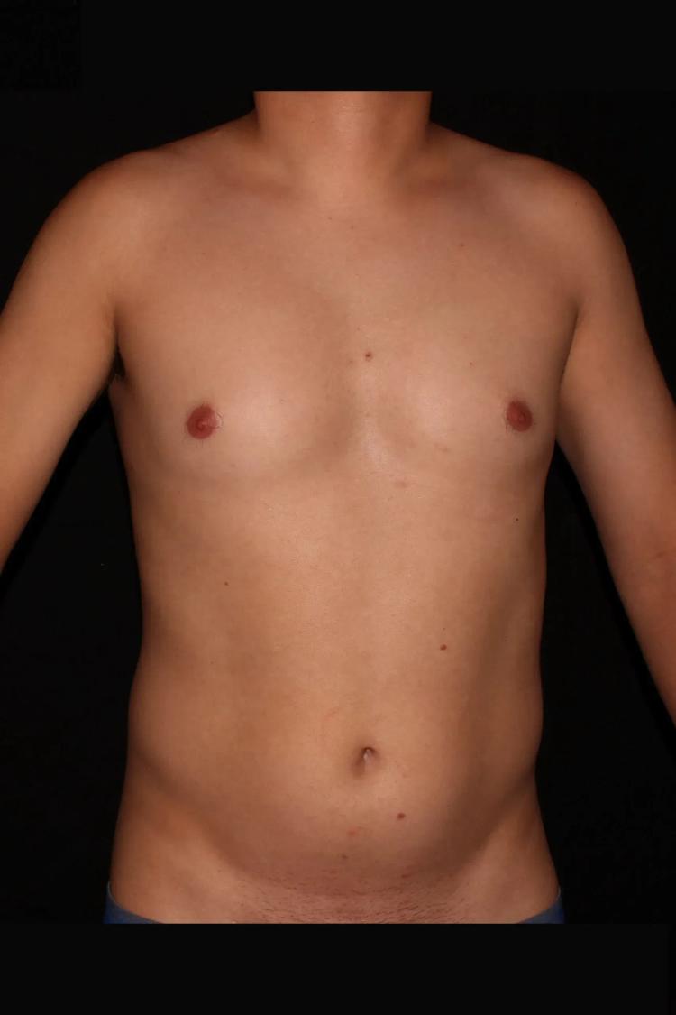 Vaser Lipo 360 (5L Max) before