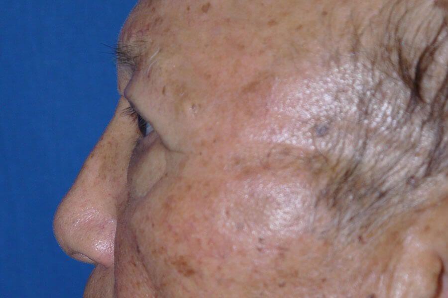 Eyelid Surgery, view 2, after
