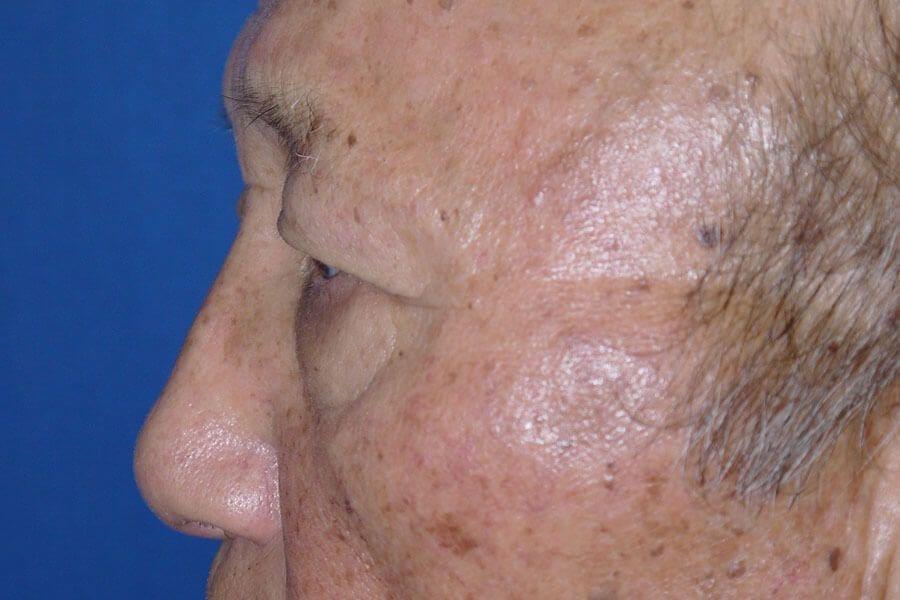 Eyelid Surgery, view 2, before