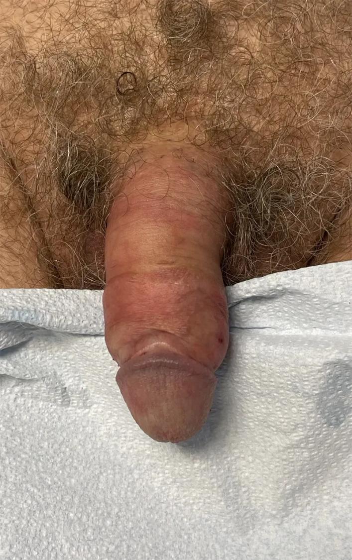 Penis Filler after