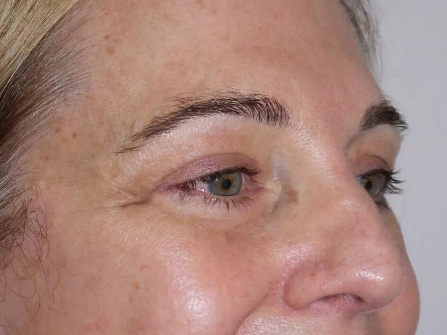 Eyelid Surgery after