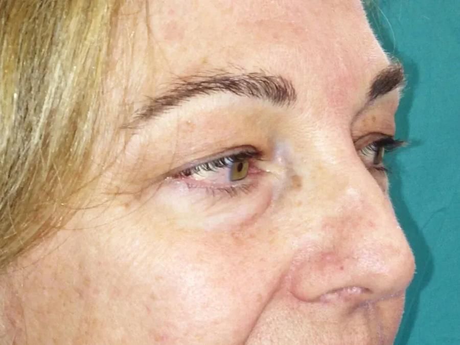 Eyelid Surgery before