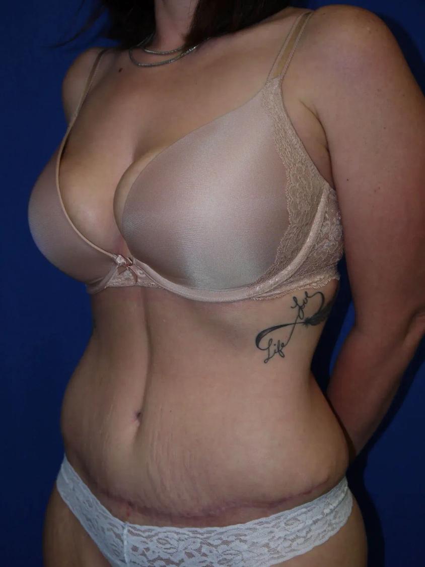 Tummy Tuck, view 2, after