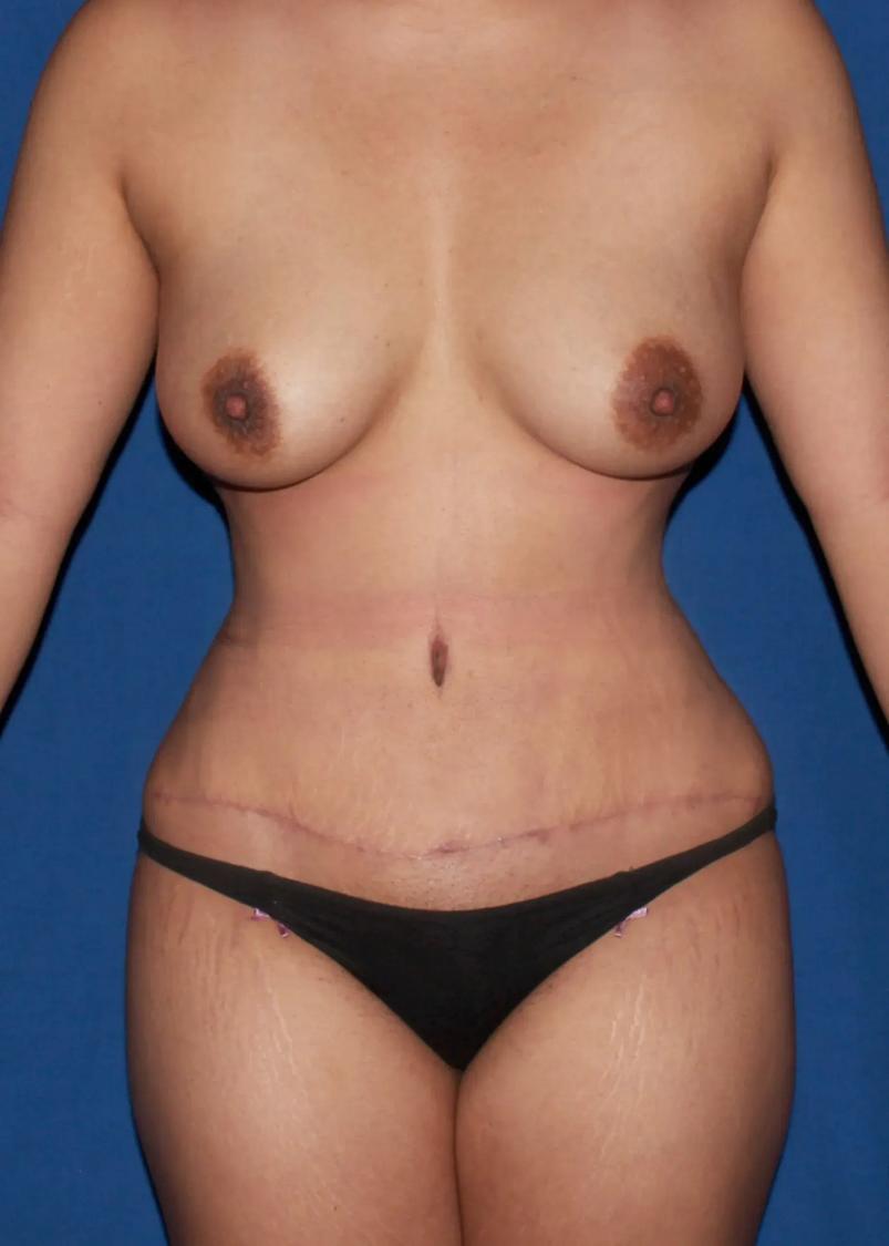 Front Liposuction (5L) (Same As Lipo360) after