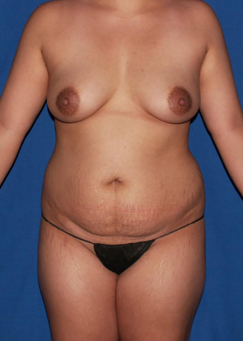 Front Liposuction (5L) (Same As Lipo360) before