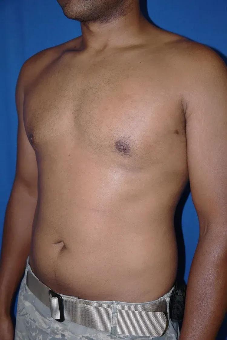 One-Stitch Gynecomastia, view 2, after