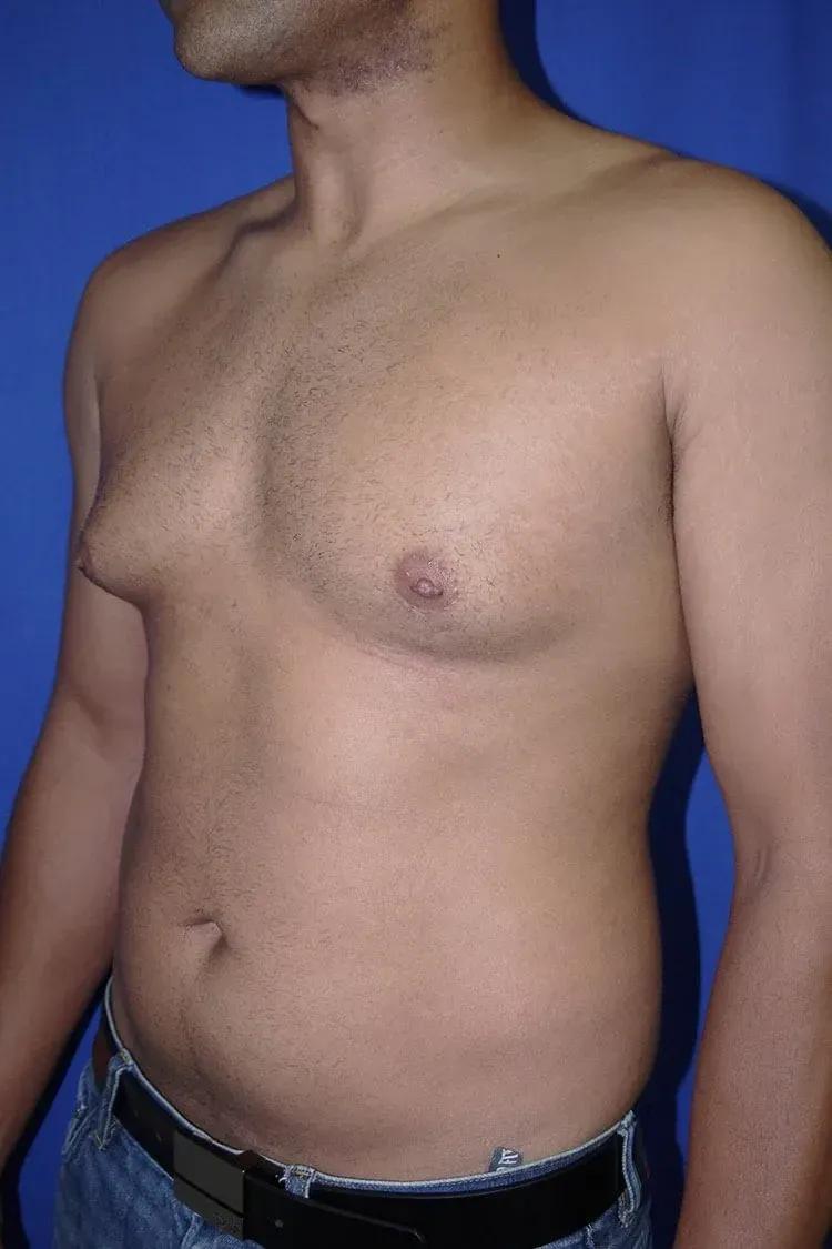 One-Stitch Gynecomastia, view 2, before