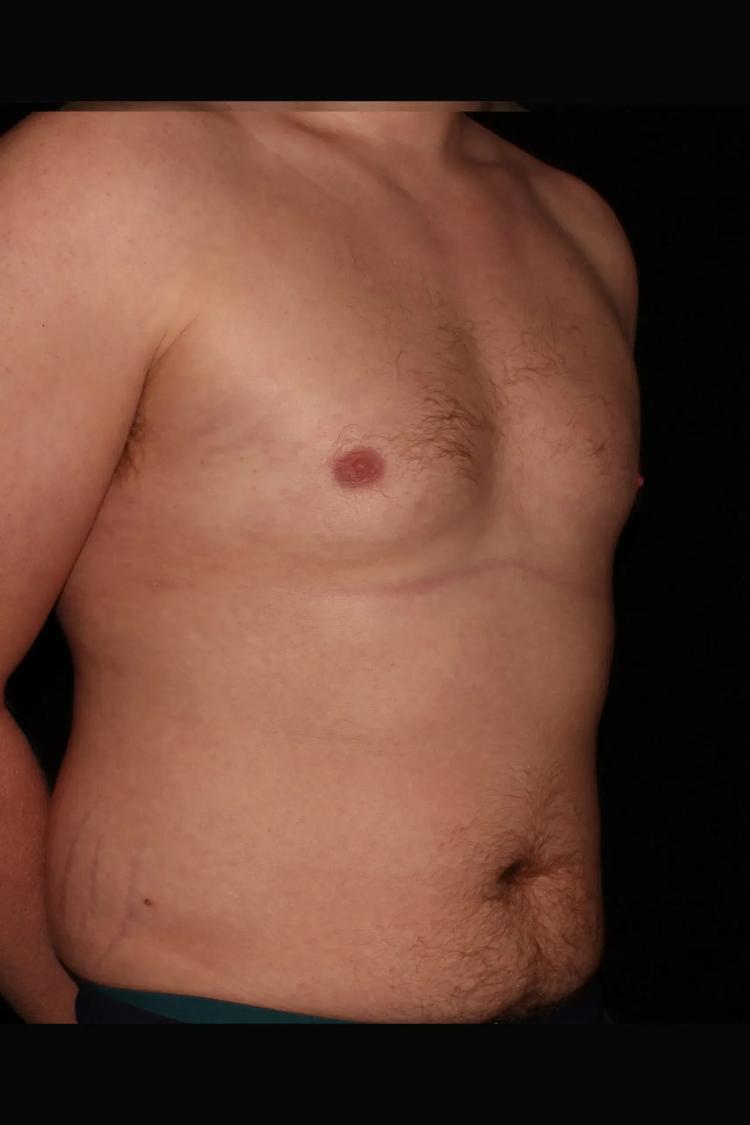 One-Stitch Gynecomastia after