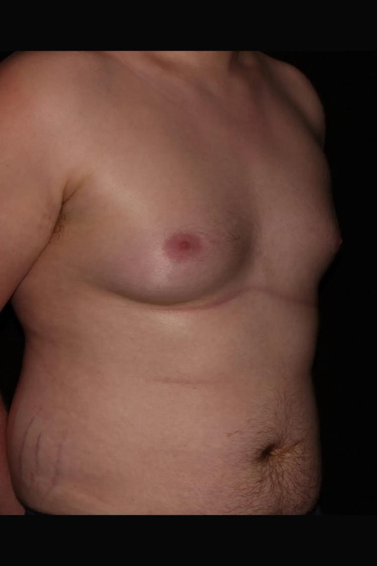 One-Stitch Gynecomastia before