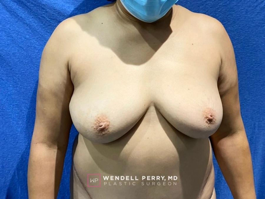 Fat Transfer To the Breast before