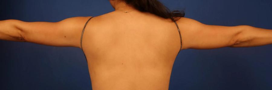 Arm Lift after