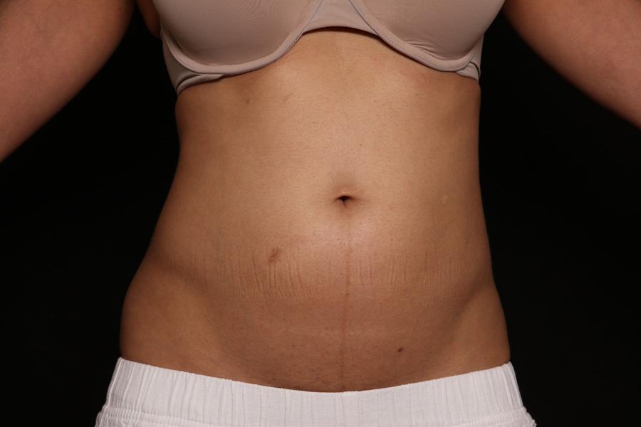 Emsculpt Neo before