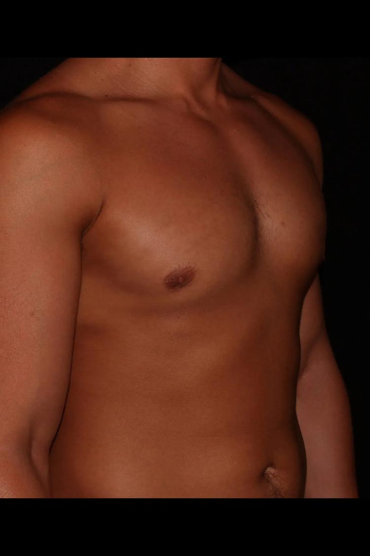 One-Stitch Gynecomastia after