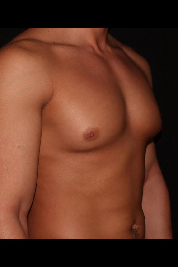 One-Stitch Gynecomastia before