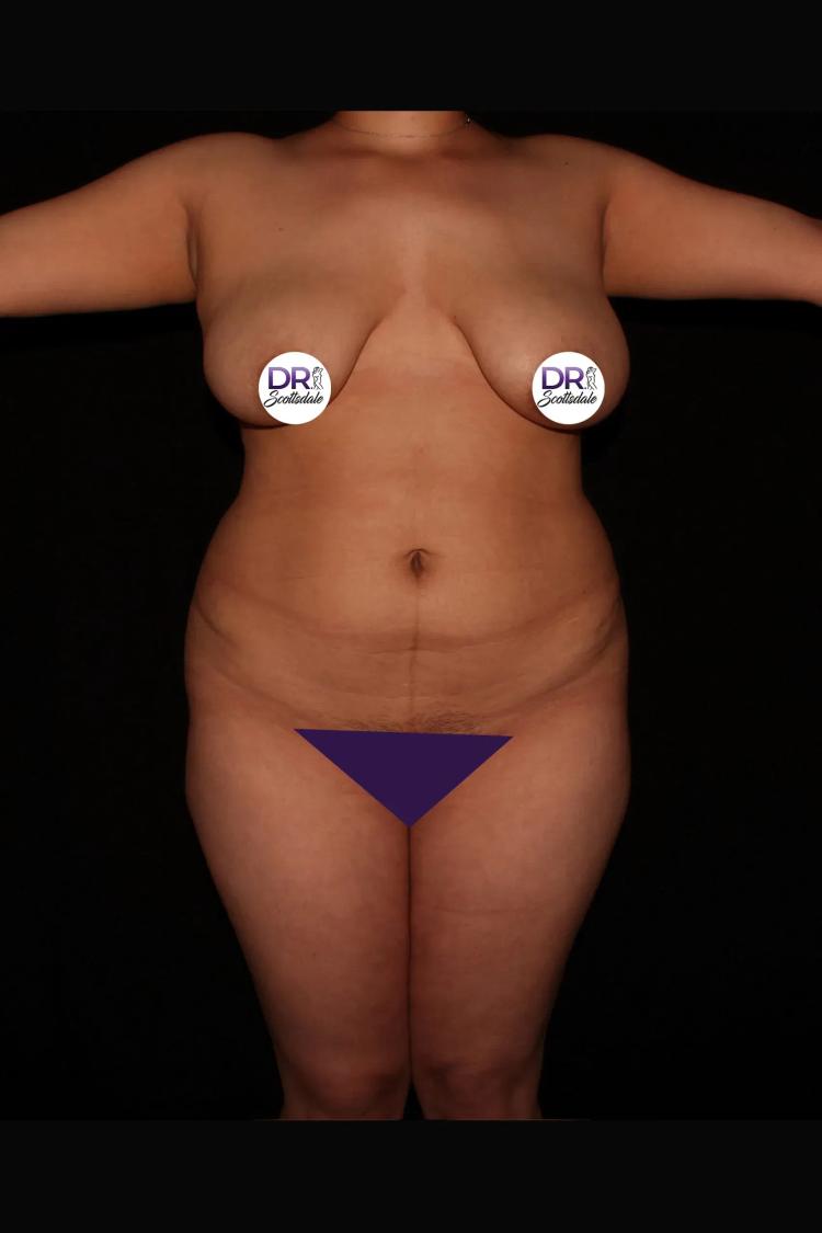 Vaser Lipo 360 (5L Max) before