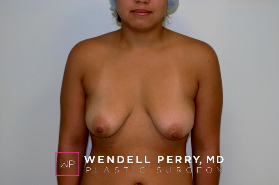 Breast Augmentation with Implants before