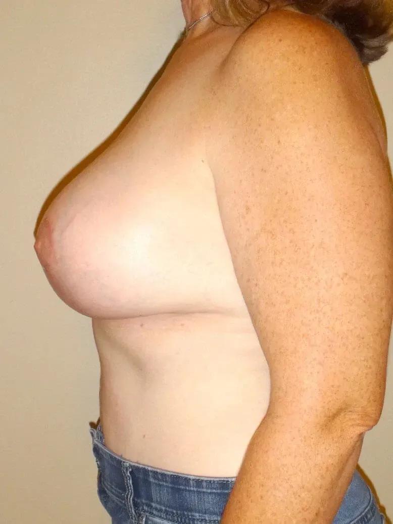 Breast Augmentation with Implants, view 3, after