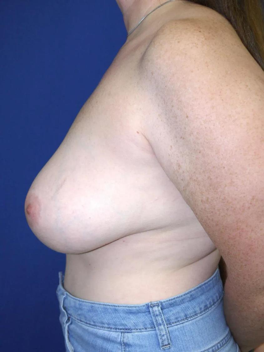 Breast Augmentation with Implants, view 3, before
