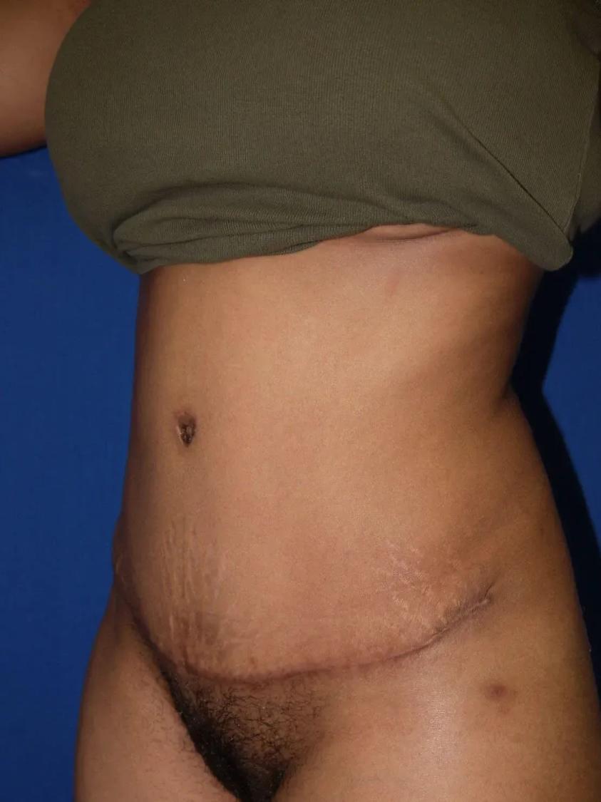 Tummy Tuck, view 2, after
