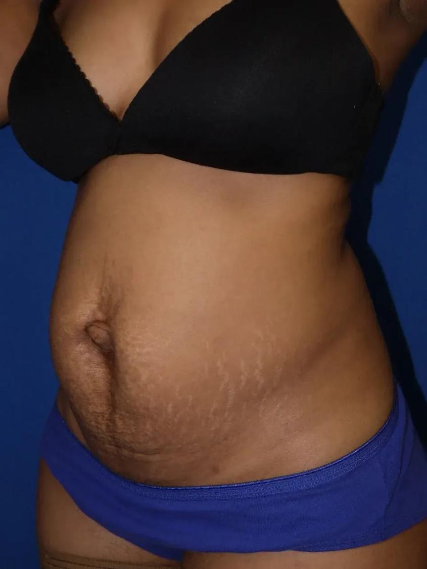 Tummy Tuck, view 2, before