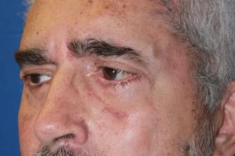 Eyelid Surgery after