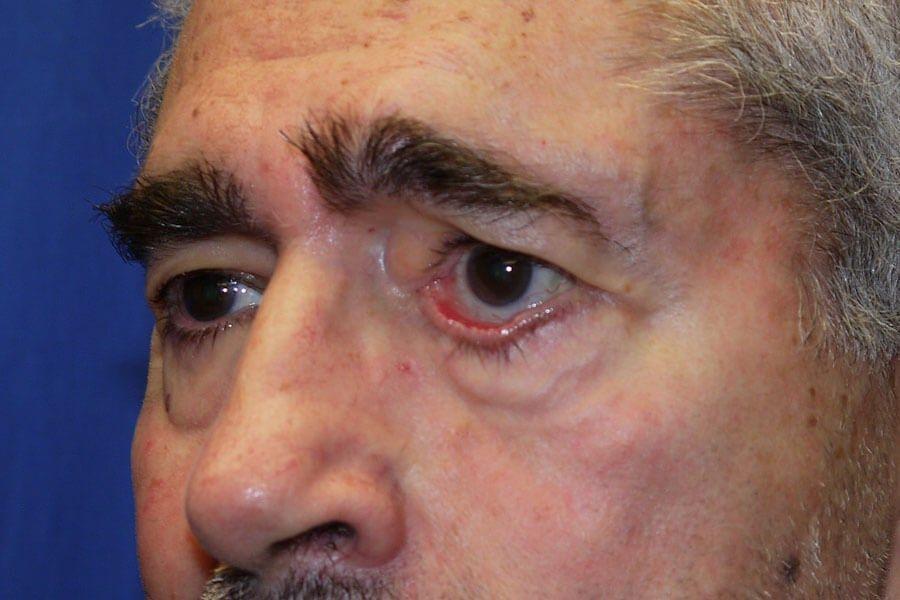 Eyelid Surgery before