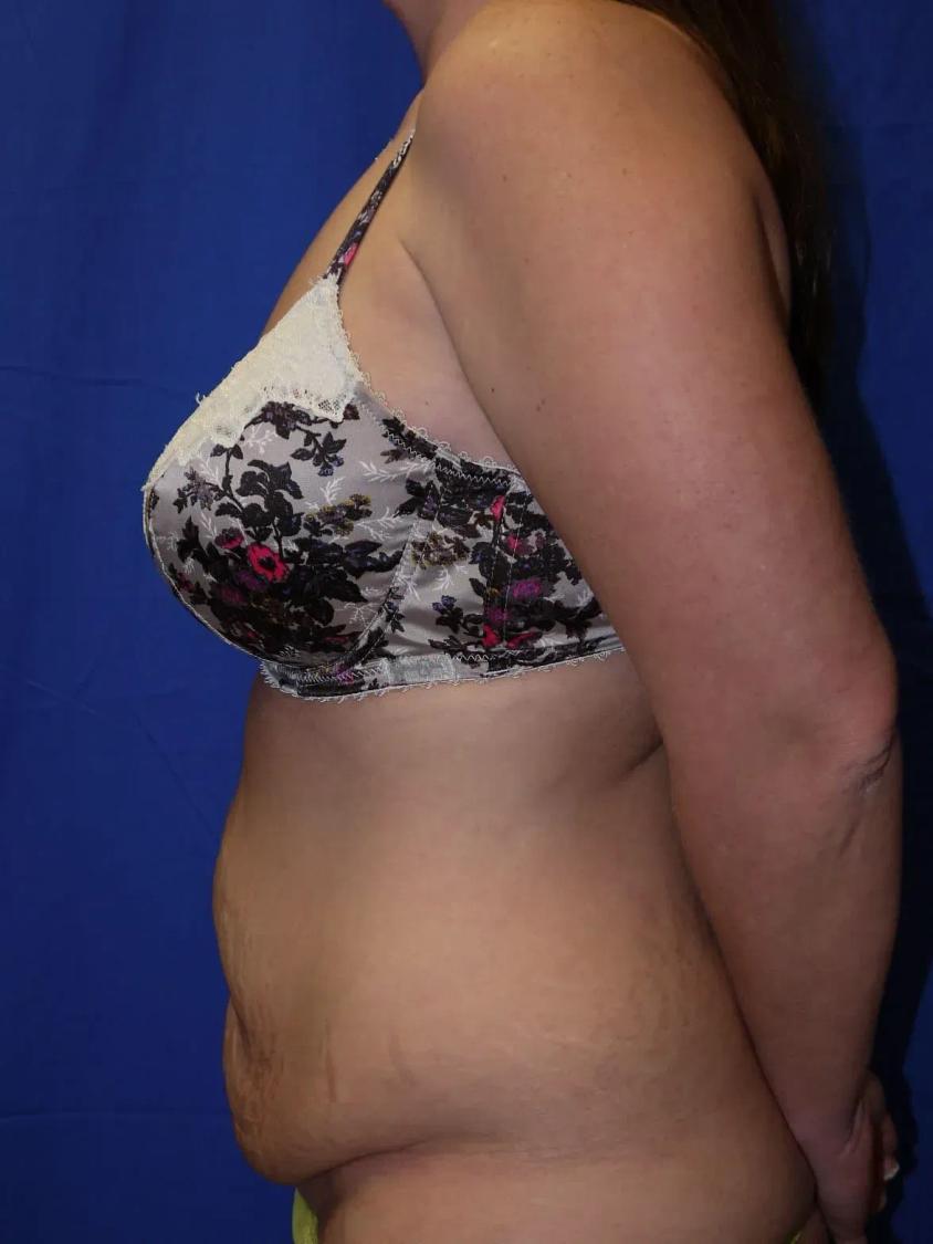 Tummy Tuck, view 4, before