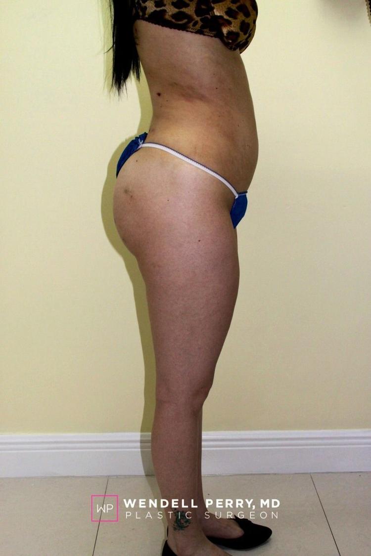 Liposuction, view 2, after