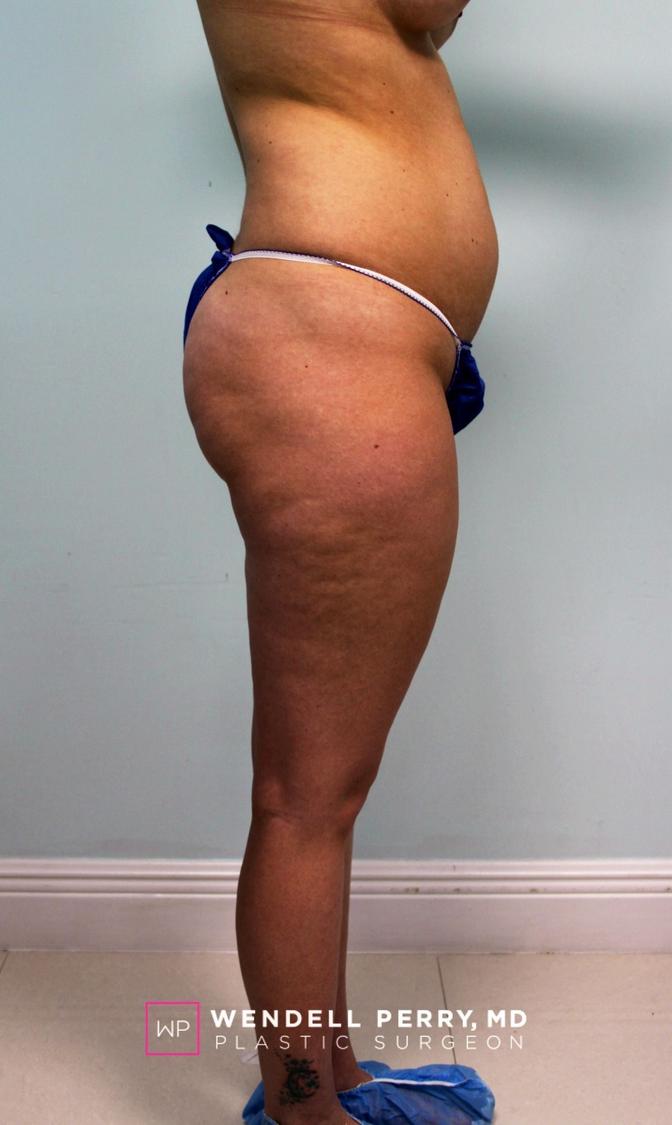 Liposuction, view 2, before