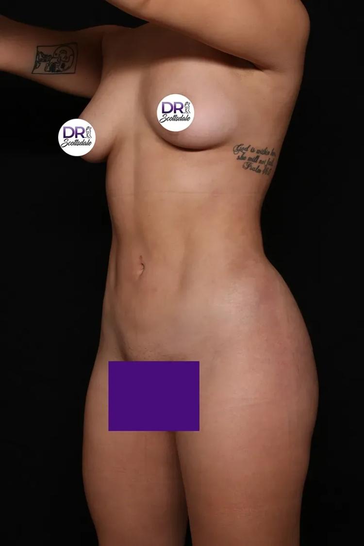 Vaser Lipo 360 (5L Max) after
