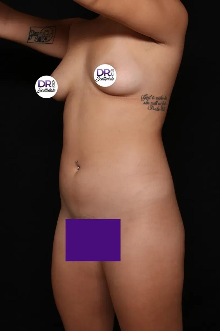 Vaser Lipo 360 (5L Max) before